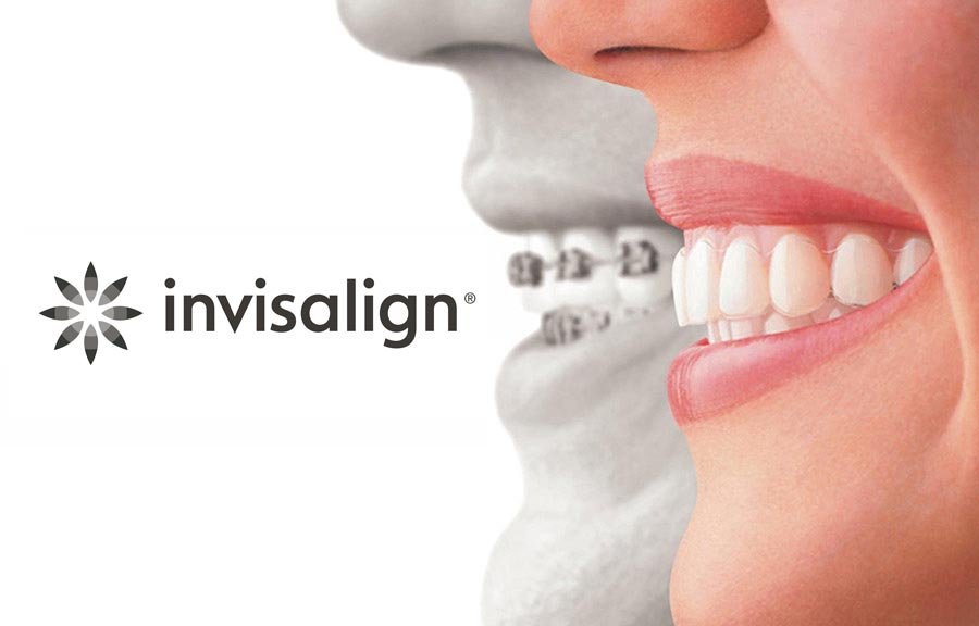 Invisalign